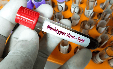 Monkeypox will not bypass Kyiv and all of Ukraine - immunologist Alla Volokha