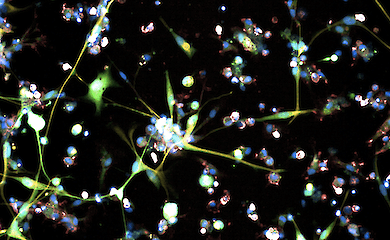 Glioblastoma cells