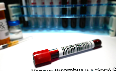 Donald Trump has been diagnosed with chronic venous insufficiency: how dangerous it is and how it is treated