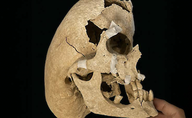 Archaeologists have found a knight with a severe skull deformity - and discovered how he lived and died