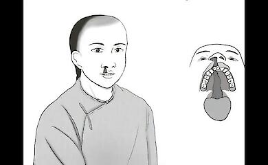 Wie behandelte man im alten China eine Person mit einer "Wolfslippe"?