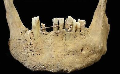 Arch&auml;ologen haben in Schottland Spuren der Zahnmedizin vor dem Aufkommen der Zahn&auml;rzte gefunden